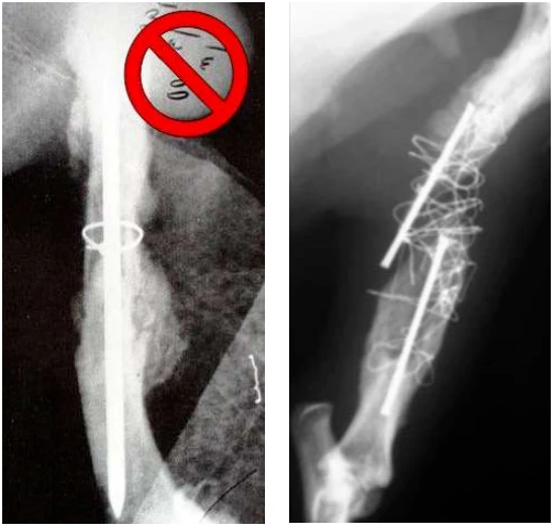 titanium vs stainless steel medical wire titanium vs stainless steel medical wire